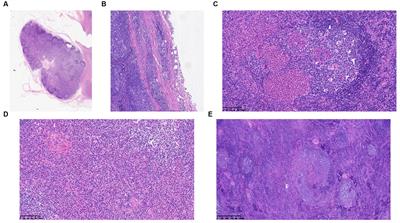 The clinical and pathological features of Kimura disease in pediatric patients